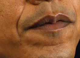 Partial or complete hair loss can affect pretty much any part of the body, including the arms and legs; Obama I Can T Grow Facial Hair Huffpost Life