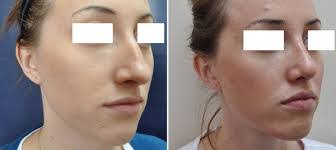 We did not find results for: What Should I Expect From Nose Job Surgery