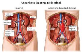 O que é a artéria aorta? Aneurisma Da Aorta Abdominal Sintomas E Cirurgia