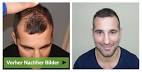 Haartransplantation bayern