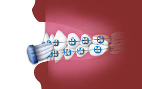 Maybe you would like to learn more about one of these? Oral Hygiene Brown Orthodontics Kinston Nc