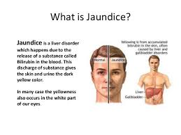Image result for jaundice
