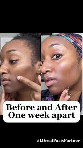 If you are ready for a change in your skin then @loréal paris usa has you  covered🙌🏾 you need to experience the transformative power of L'Oréal  Paris Dark Spot Serum. This remarkable serum is your key ...