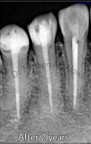 Check spelling or type a new query. Ø±Ø§Ø¦Ø¯ Ø§Ù„Ø³Ø¯Ø­Ø§Ù† Rsadhan On Twitter This Periapical Radiograph Of The Lower Right Premolars Show Heavily Restored Teeth With Poor Rct And A Large Well Defined Corticated Unilocular Round Periapical Radiolucency That Is Most
