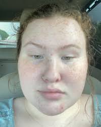 This girl needs some skincare help!