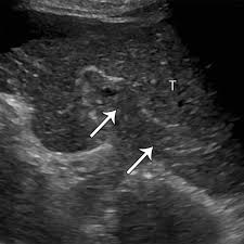 Descubre la mejor forma de. Multimodality Imaging Of Abdominopelvic Tumors With Venous Invasion Radiographics