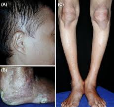 The medical term for hair loss is alopecia. Hypotrichosis An Overview Sciencedirect Topics