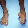 Club foot can affect 1 or both feet. 1