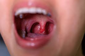 Image result for Tonsillitis