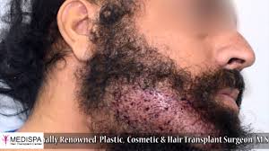 Sunil arora and his expert team of doctors have been conistently delivering results for his patients for more than the past two decades. Beard Hair Transplant India Jaipur Delhi At Medispa By Dr Suneet Soni Check Out This Beard Hair Hair Transplant Hair And Beard Styles Hair Transplant In India