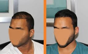 Diffuse hair loss is one of the most distressing forms of hair loss since it looks and feels like you're losing all of your hair at once instead of in a more for one thing, diffuse hair loss isn't necessarily progressive or permanent. Patient 13 Hair Transplant On Patient With Advanced Diffuse Hair Loss