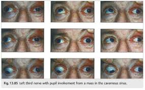 Image result for Pupillary Paralysis