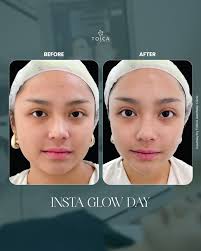 Our Instaglow Day treatment is your secret to instant, radiant skin! 🌟  With microdermabrasion + brightening laser, you'll see smoother, brighter  skin after just one session. Be the best version of your