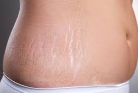 Pulsed dye lasers, such as vbeam. How To Get Rid Of Stretch Marks Home Treatment Prevention