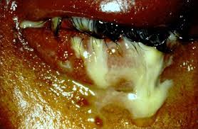 Image result for Gonococcal Conjunctivitis