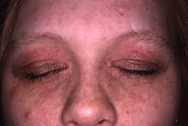 Lesen sie mehr zur akuten behandlung und täglichen pflege. Die Atopische Dermatitis Beim Erwachsenen Eczema Foundation