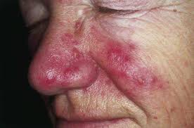 Érythème permanent, télangiectasies et la kératite de la rosacée peut constituer un problème grave avec risque d'ulcérations cornéennes. Couperose Rosacee Et Erythrose Traitement Au Laser