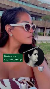Karina Karina!1 1/2 years after her face and neck lift, she looks better  than ever !!!Check out the Karina highlight