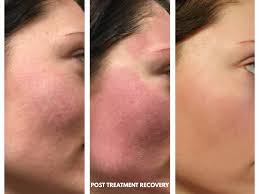 Check spelling or type a new query. Microneedling Moncton Sparkle Lifestyle Medispa