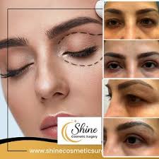 TOP 10 BEST Blepharoplasty in West Covina, CA