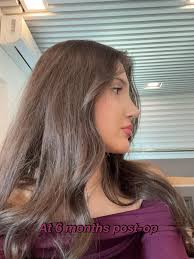 What do you guys think of her new profile?! 💜 REVISION RHINOPLASTY BEFORE  & 1 YEAR POST OP 👃👍 Trusted with Noses Worldwide®  ———————————————————————— 📱 📱 Text us at: 1 (424) 383-6509