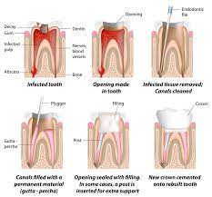 Sep 01, 2020 · how long does a root canal on a front tooth take? Root Canal Treatment Healthdirect