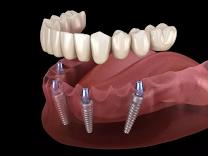 IMPLANTS product image