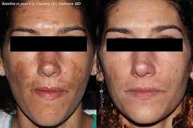 Image result for Melasma