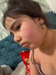 Buna ziua ! Am o fetita de 8 ani de 6 zile i-au apărut aceste erupții pe  piele și obraji .Medicii de la Marie Curie i-au făcut analize au zis ca ei