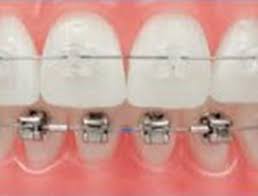 Maybe you would like to learn more about one of these? Damon Braces Orthodontics The James Clinic