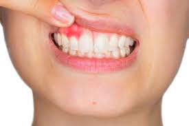 We did not find results for: Gum Disease Treatment Ocala Fl Crystal River Fl