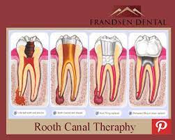 Frandsen Dental Root Canal Therapy Root Canal Dental Dentist