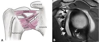 The conjoint tendon (previously known as the inguinal aponeurotic falx) is a sheath of connective tissue formed from the lower part of the common aponeurosis of the abdominal internal oblique muscle and the transversus abdominis muscle, joining the muscle to the pelvis. Shoulder Anatomy And Normal Variants Abstract Europe Pmc
