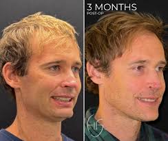 I realized very early that having experience in reconstructive surgery is  an invaluable asset for understanding and performing aesthetic surgery.  Nothing gives a surgeon a better understanding of anatomical form and  function.