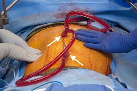 HIPEC (hyperthermic intraperitoneal chemotherapy) is performed... |  Download Scientific Diagram
