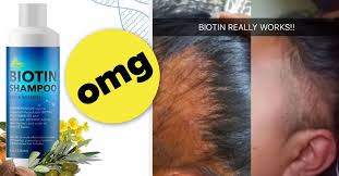 Biotin And Collagen Shampoo Before And After This Biotin Shampoo S Before And After Photos Will Have You Believing In Miracles Biotin Shampoo Biotin Shampoo