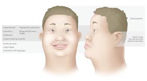 An abnormally long vertical groove in the center of the upper lip (philtrum); Down Syndrome Amboss