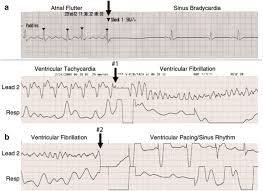Image result for Synchronized Cardioversion