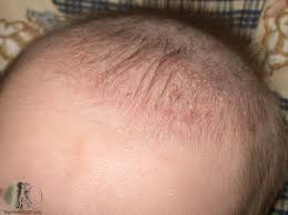 Image result for white scabs on the head in children