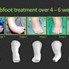 Most clubfeet can be successfully corrected using the nonsurgical ponseti method. 1