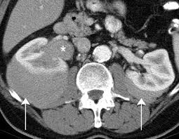 Image result for Perinephric Abscess