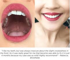 How much your braces cost will depend highly on where you live. Become Teledentistry Startup For Invisible Braces Without Dentist Visits