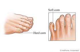 The Foot And Ankle Blog Of North Carolina Corns Areas Of Thick Hardened Dead Skin On Your Toe Get Rid Of Corns Corn Treatment Corn On Toe
