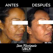 BYE BYE CICATRICES: ECO2 ✨ Se trata...