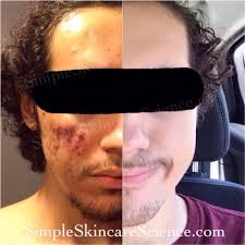 Rinsing your mouth with a salt water solution is an effective remedy for getting rid of lie bumps. How To Get Rid Of Acne Overnight With Black Voodoo Magic
