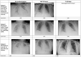 Neurorx And Relief Therapeutics Announce Enrollment Of 150 Patients In Phase 2b 3 Trial Of Rlf 100 For Critical Covid 19 With Respiratory Failure Biospace