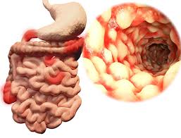 De ziekte van crohn is een chronische aandoening van het spijsverteringsstelsel, waarbij het hele spijsverteringsstelsel (vanaf de mond tot de aars) in meer of mindere mate ontstoken kan zijn. Wat Zijn Chronische Inflammatoire Darmziekten Gezondheid Be