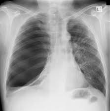 We did not find results for: Pulmonary Bullae Radiology Reference Article Radiopaedia Org