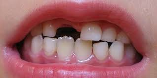 Visul in care pierzi un dinte sanatos aduce cu sine o multitudine de interpretari. Dintii Intr O Carte De Vis A Unui Copil Interpretarea Viselor Dinte SfaÈ™iat Cu Sange