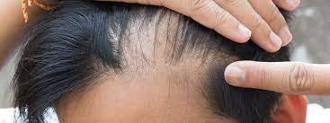 Other causes of hair loss. Causes Of Hair Loss In Teenage Males